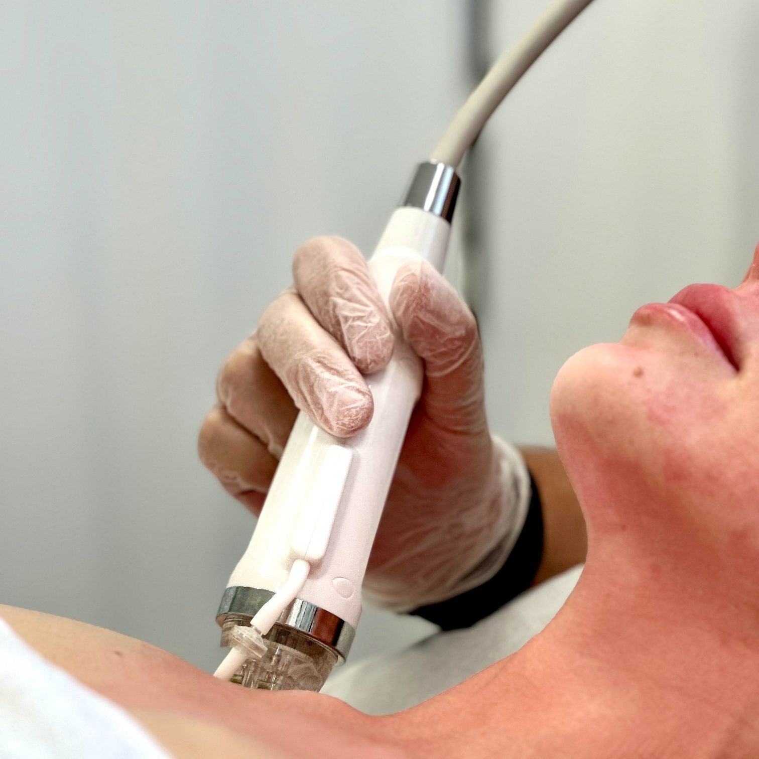 MICRONEEDLING
